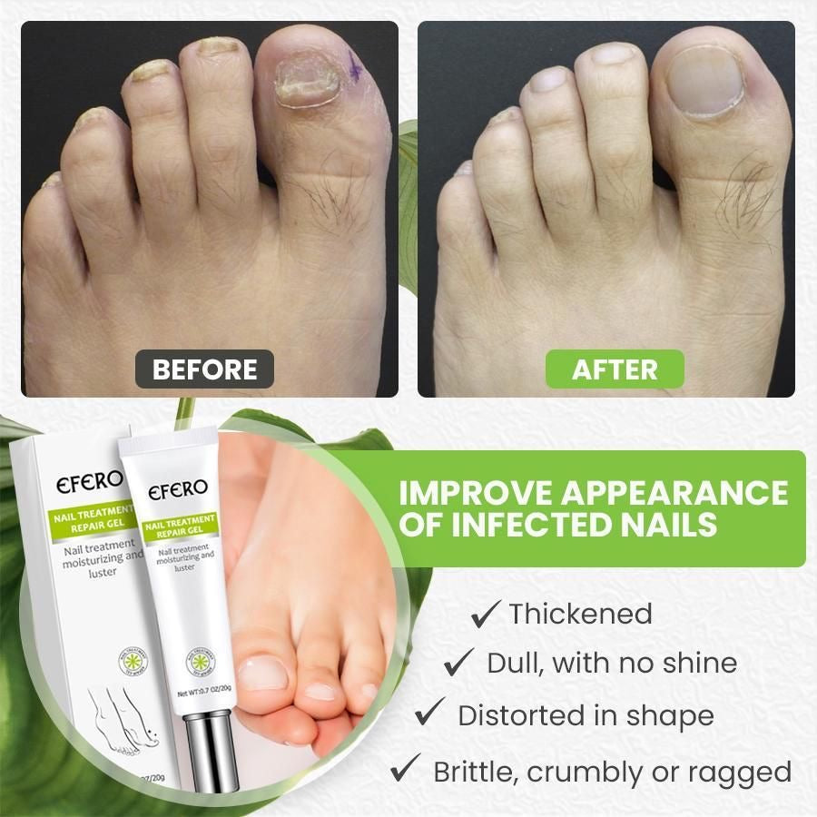 Efero Nails Treatment Gel – Traitement Antifongique Réparateur